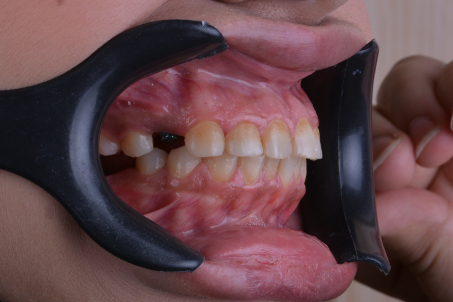 قبل تغير لون و شكل الأسنان لإعادة تأهيل الابتسامة.